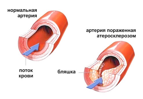 Атеросклероз картинка