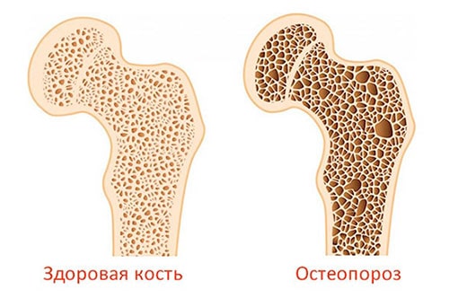 Остеопороз картинка